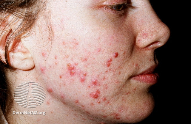 File:Acne (DermNet NZ acne-vulgaris-002).jpg
