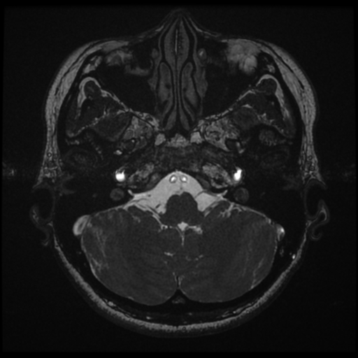 Acoustic neuroma (Radiopaedia 34049-35283 Axial 34).png