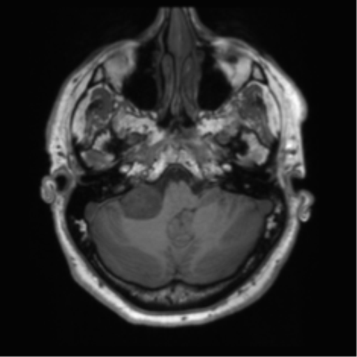 File:Acoustic schwannoma (Radiopaedia 50846-56358 Axial T1 14).png