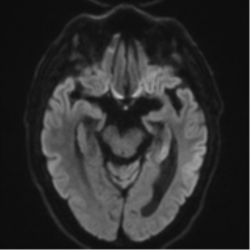 Acoustic schwannoma (Radiopaedia 55729-62281 E 37).png