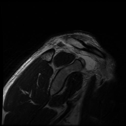 File:Acromioclavicular joint dislocation (Radiopaedia 14218-14076 Sagittal T2 11).jpg