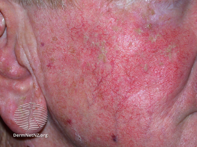 Actinic Keratoses affecting the face (DermNet NZ lesions-ak-face-416).jpg