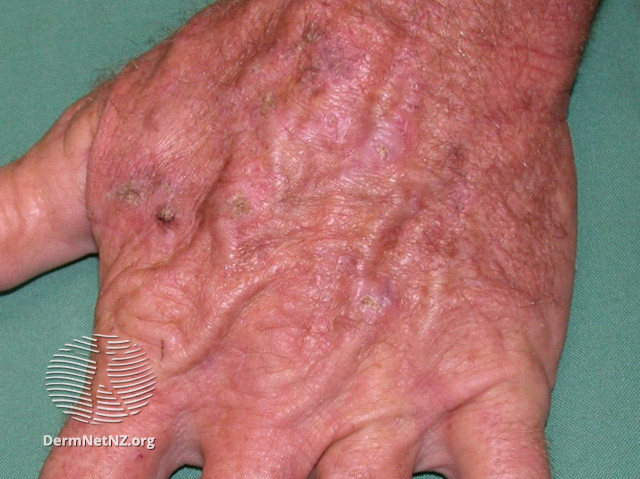 File:Actinic keratoses affecting the hands (DermNet NZ lesions-ak-hands-518).jpg