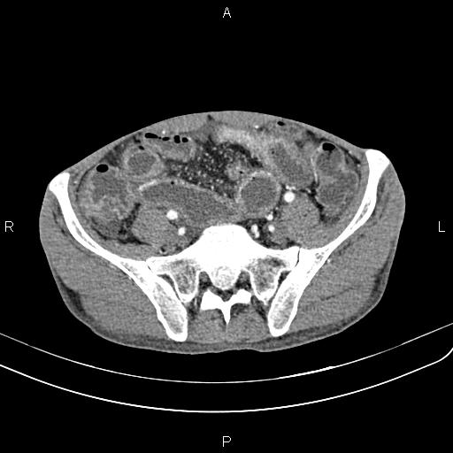Active crohn disease (Radiopaedia 87133-103397 Axial C+ arterial phase 77).jpg