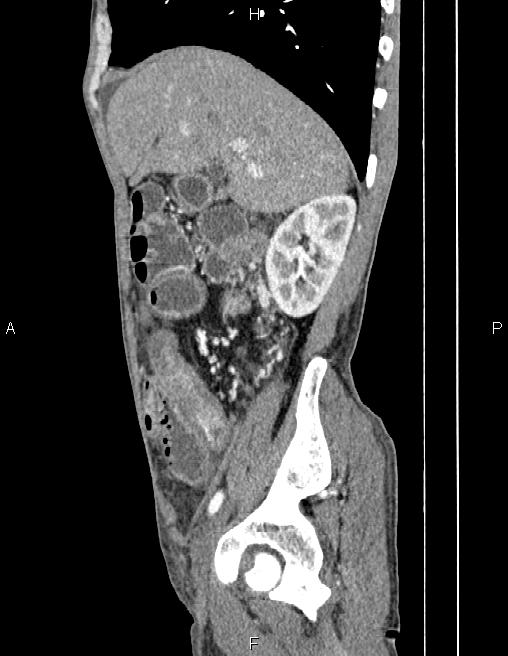 Active crohn disease (Radiopaedia 87133-103397 Sagittal C+ arterial phase 24).jpg