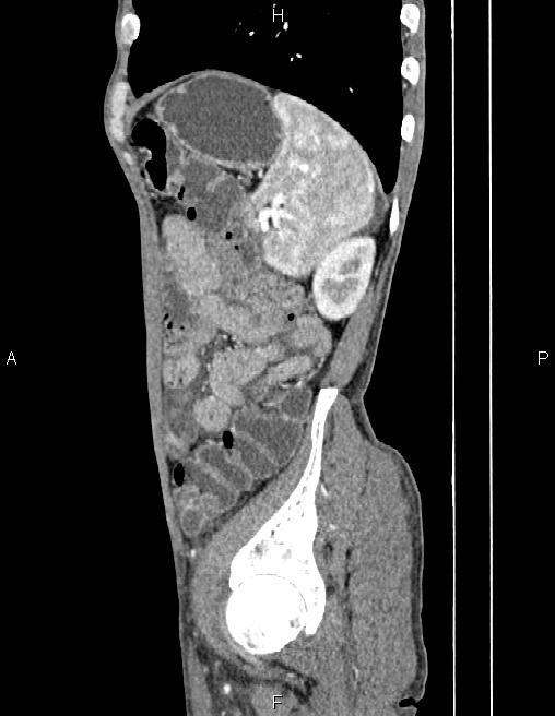 Active crohn disease (Radiopaedia 87133-103397 Sagittal C+ arterial phase 72).jpg