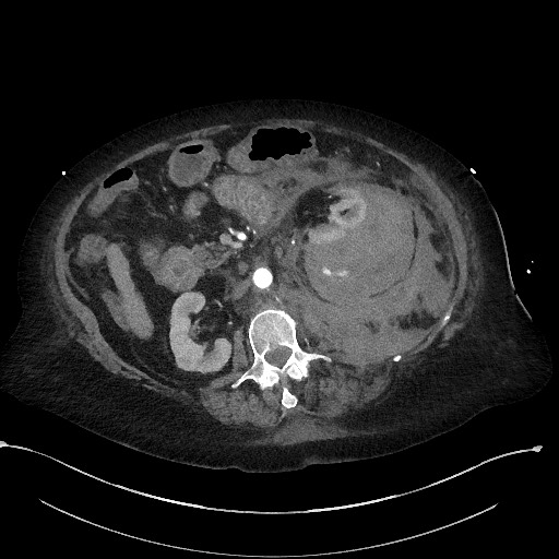 File:Active renal extravasation with large subcapsular and retroperitoneal hemorrhage (Radiopaedia 60975-68796 Axial C+ arterial phase 83).jpg