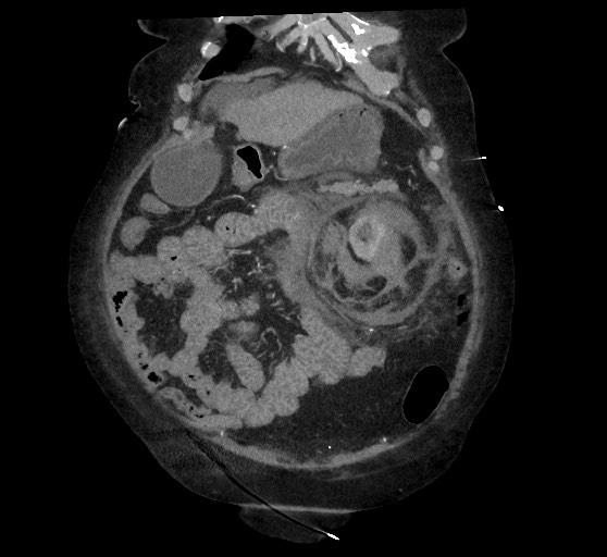 Active renal extravasation with large subcapsular and retroperitoneal hemorrhage (Radiopaedia 60975-68796 Coronal C+ arterial phase 43).jpg
