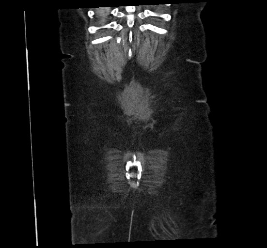 File:Active renal extravasation with large subcapsular and retroperitoneal hemorrhage (Radiopaedia 60975-68796 Coronal C+ portal venous phase 139).jpg