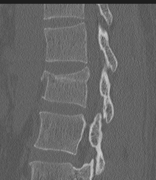 Acute L1 burst compression fracture (Radiopaedia 34430-35755 Sagittal bone window 27).png