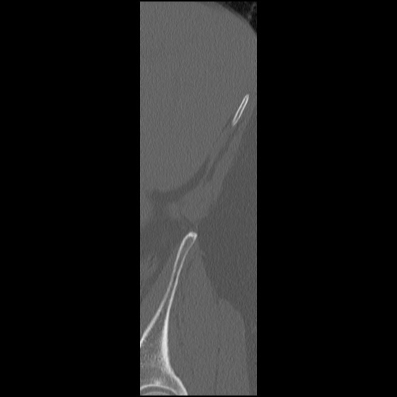 Acute Schmorl's node (Radiopaedia 83276-102365 Sagittal bone window 87).jpg