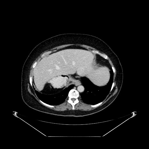 Acute appendicitis, heterotaxy syndrome (Radiopaedia 66884-76202 Axial C+ portal venous phase 23).jpg