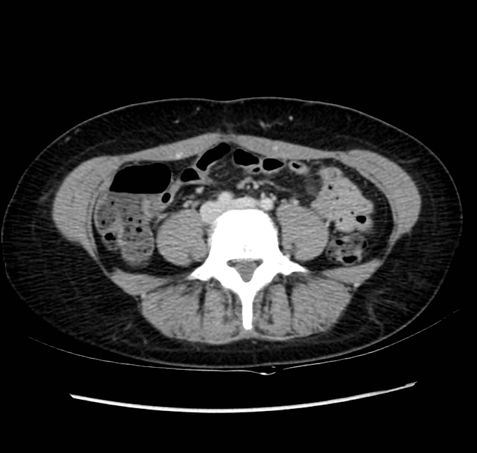 Acute appendicitis (Radiopaedia 22892-22918 Axial C+ portal venous phase 51).png