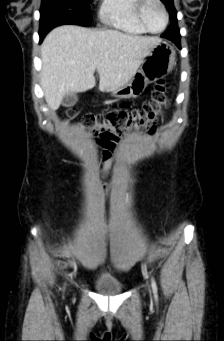 Acute appendicitis (Radiopaedia 22892-22918 Coronal C+ portal venous phase 9).png