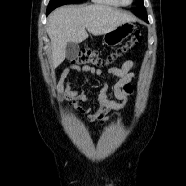 Acute appendicitis (Radiopaedia 38255-40270 Coronal C+ portal venous phase 22).jpg