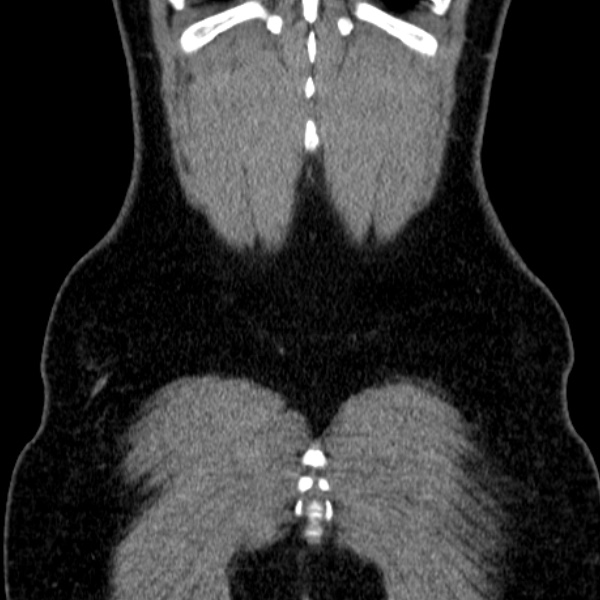 File:Acute appendicitis (Radiopaedia 38255-40270 Coronal C+ portal venous phase 83).jpg