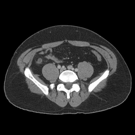 Acute appendicitis (Radiopaedia 48511-53463 Axial C+ portal venous phase 71).jpg