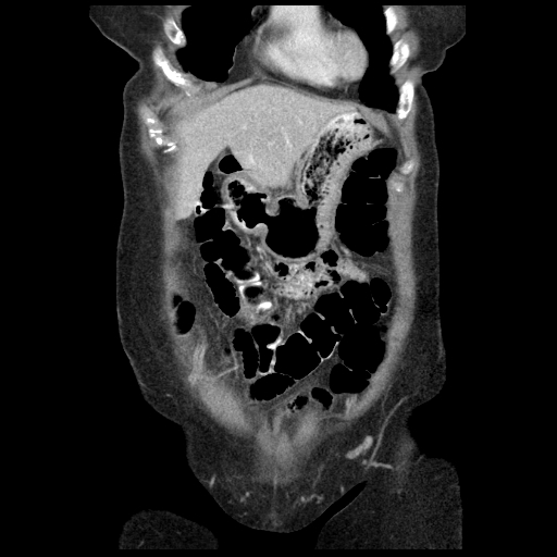 Acute appendicitis (Radiopaedia 52672-58589 Coronal C+ portal venous phase 5).jpg