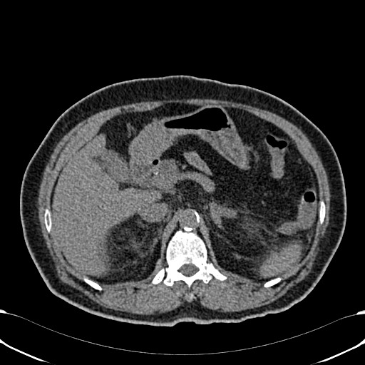 Acute appendicitis (Radiopaedia 58627-65818 Axial non-contrast 27).jpg
