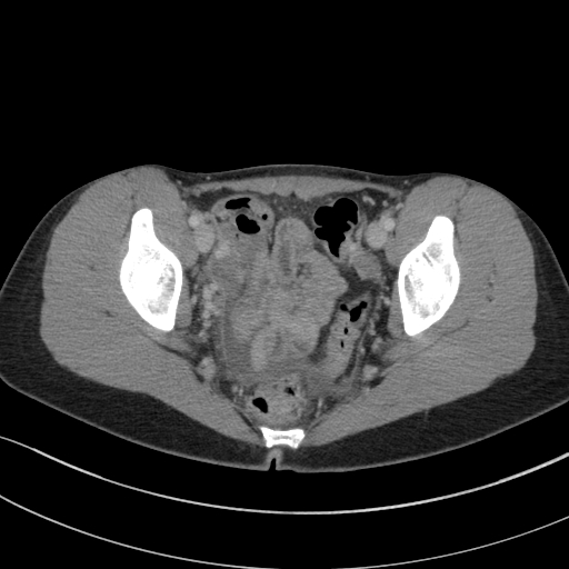 Acute appendicitis (Radiopaedia 62608-70901 Axial C+ portal venous phase 43).jpg