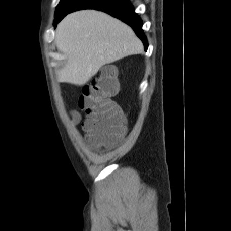 Acute appendicitis (Radiopaedia 66513-75790 Sagittal C+ portal venous phase 15).jpg