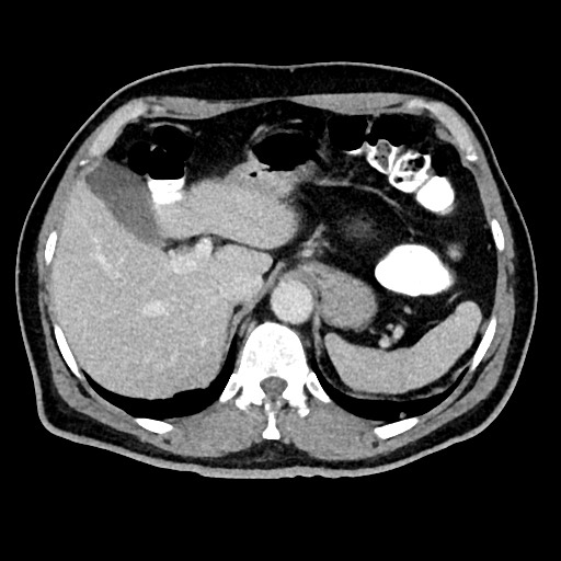 Acute appendicitis (Radiopaedia 77016-88960 Axial C+ portal venous phase 34).jpg