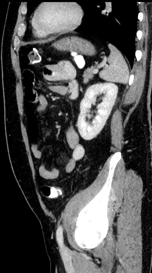 Acute appendicitis (Radiopaedia 77016-88960 Sagittal C+ portal venous phase 33).jpg