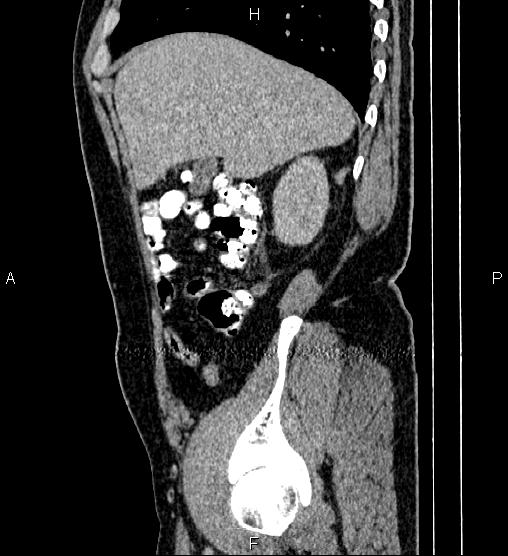 Acute appendicitis (Radiopaedia 84780-100240 Sagittal C+ portal venous phase 22).jpg
