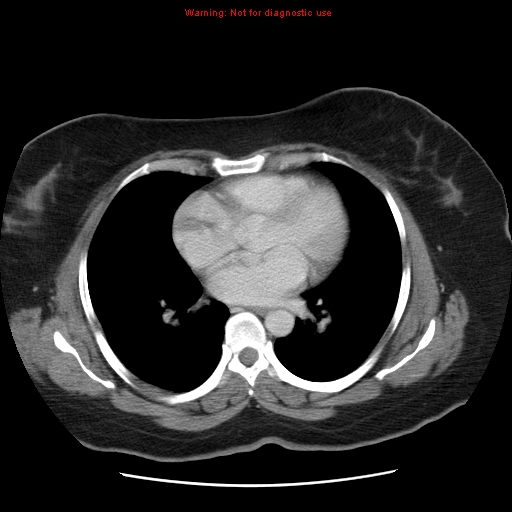 File:Acute appendicitis complicated by ovarian vein thrombophlebitis (Radiopaedia 16172-15851 Axial C+ portal venous phase 4).jpg