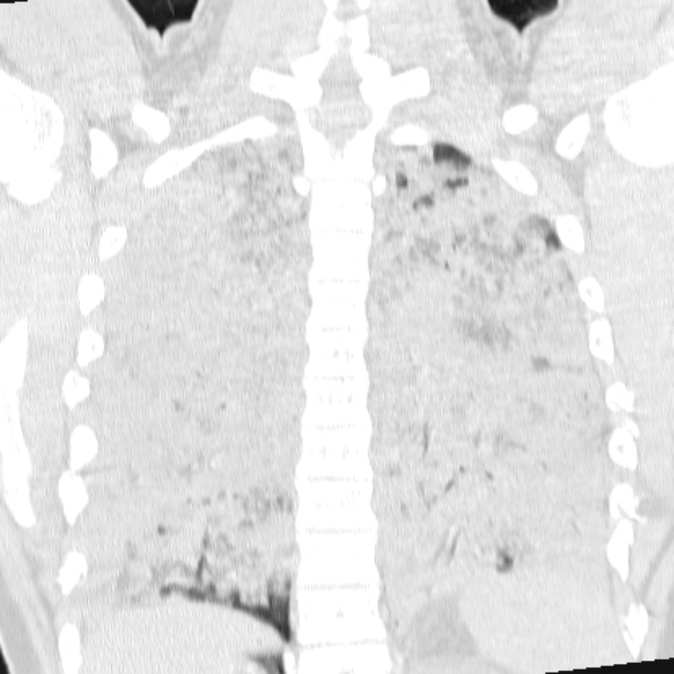 Acute aspiration pneumonitis (Radiopaedia 33605-34703 Coronal lung window 58).jpg