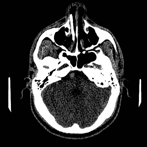 Acute basilar artery occlusion (Radiopaedia 43582-46985 Axial non-contrast 58).jpg