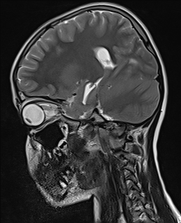 File:Acute cerebellar ataxia (Radiopaedia 61487-69446 Sagittal T2 3).jpg