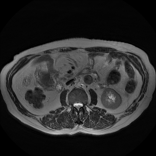 File:Acute cholecystitis complicated by pylephlebitis (Radiopaedia 65782-74915 Axial T2 29).jpg