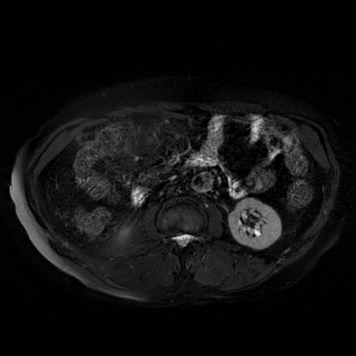 File:Acute cholecystitis complicated by pylephlebitis (Radiopaedia 65782-74915 Axial T2 fat sat 33).jpg