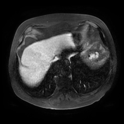 Acute cholecystitis complicated by pylephlebitis (Radiopaedia 65782-74915 Axial arterioportal phase T1 C+ fat sat 10).jpg