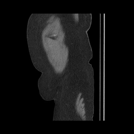 File:Acute cholecystitis with tensile fundus sign (Radiopaedia 71394-81723 Sagittal non-contrast 153).jpg