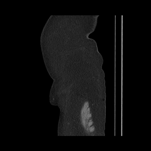 Acute cholecystitis with tensile fundus sign (Radiopaedia 71394-81723 Sagittal non-contrast 25).jpg