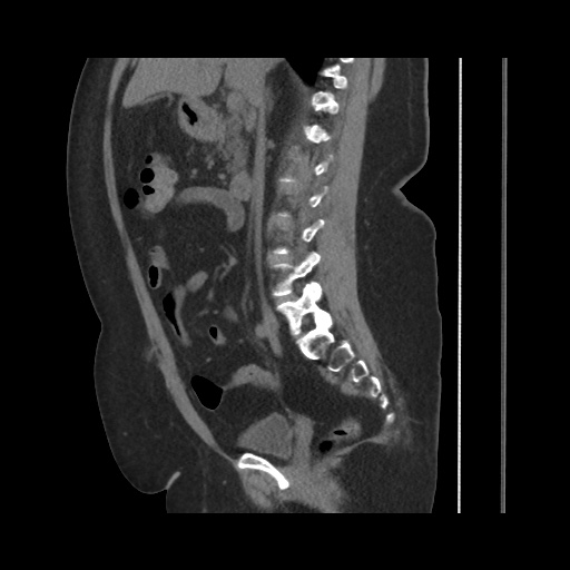 Acute cholecystitis with tensile fundus sign (Radiopaedia 71394-81723 Sagittal non-contrast 81).jpg