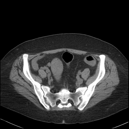 Acute colonic hemorrhage in ulcerative colitis (Radiopaedia 77415-89538 Axial non-contrast 105).jpg