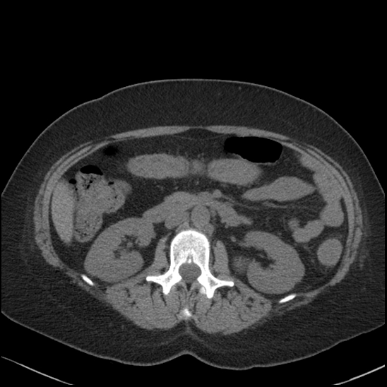 Acute colonic hemorrhage in ulcerative colitis (Radiopaedia 77415-89538 Axial non-contrast 56).jpg