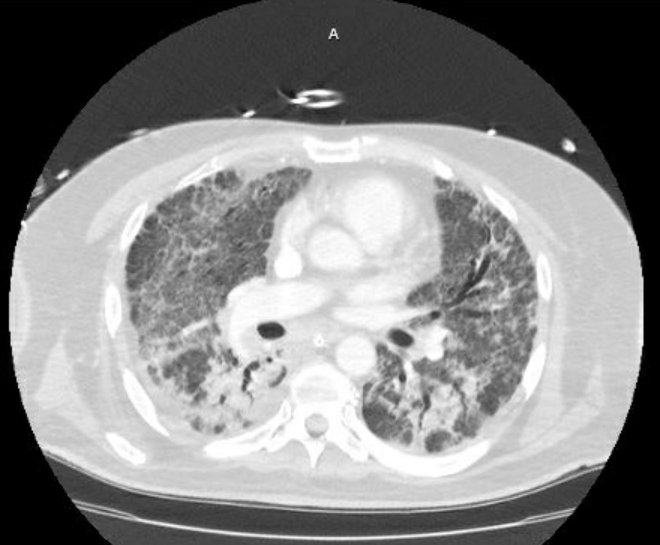 Acute cor pulmonale (ultrasound) (Radiopaedia 83508-98818 Axial lung window 46).jpg