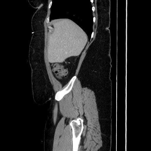 Acute diverticulitis - transverse colon (Radiopaedia 87063-103327 Sagittal C+ portal venous phase 64).jpg