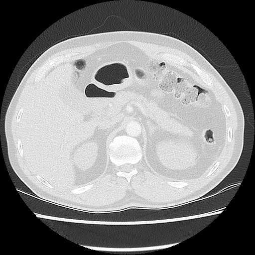 Acute epicardial fat necrosis (Radiopaedia 42327-45440 Axial lung window 57).jpg