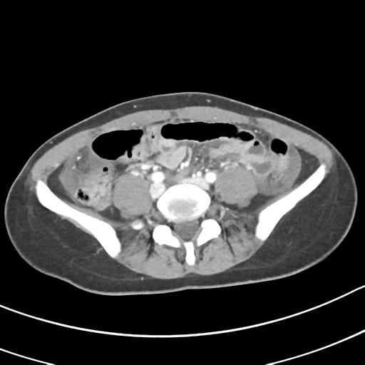 Acute gangrenous appendicitis with perforation (Radiopaedia 40152-42662 Axial C+ portal venous phase 47).png