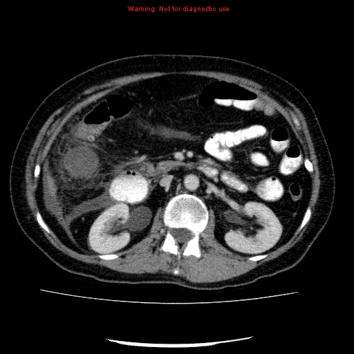 Acute gangrenous cholecystitis (Radiopaedia 10123-10661 Axial C+ portal venous phase 42).jpg
