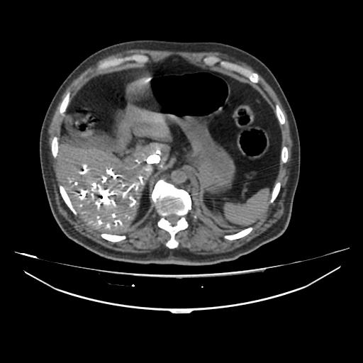Acute heart failure (CT) (Radiopaedia 79835-93075 Axial C+ arterial phase 83).jpg