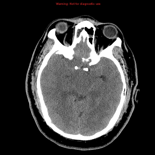 File:Acute hemorrhagic leukoencephalitis (Radiopaedia 14076-13920 Axial non-contrast 19).jpg