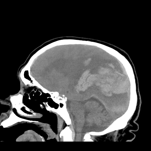 File:Acute hemorrhagic stroke (Radiopaedia 17507-17223 Sagittal non-contrast 20).jpg
