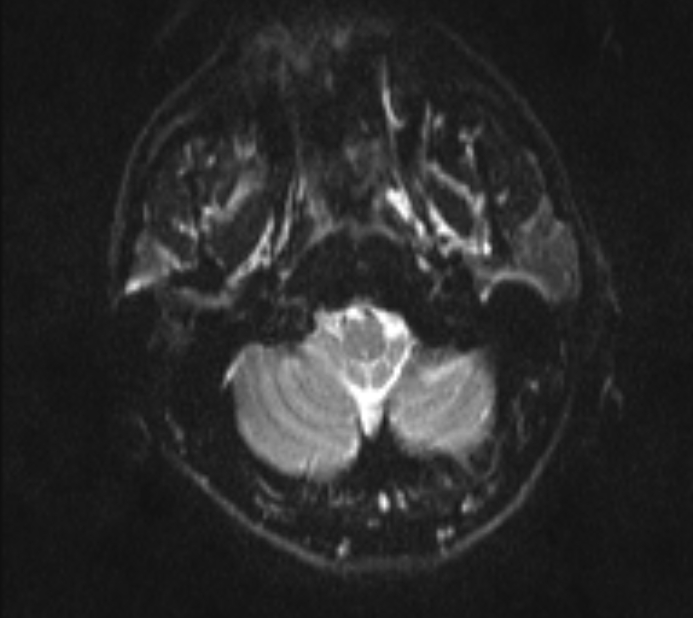 Acute ischemic stroke - posterior circulation territory (Radiopaedia 77670-89880 Axial DWI 3).jpg