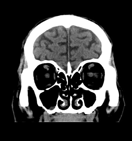 File:Acute left anterior cerebral artery territory infarction (Radiopaedia 51785-57578 Coronal non-contrast 12).jpg